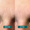 facial patches HYALURON | Apricot