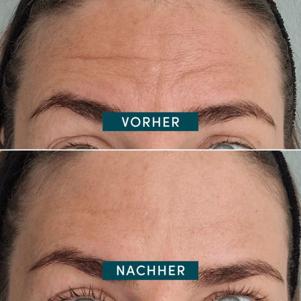 forehead pad ECTOÏNE | Apricot