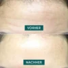 forehead pad HYALURON | Apricot