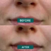 mouth patches HYALURON | Apricot