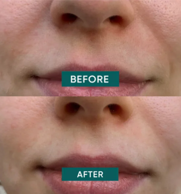 mouth patches HYALURON | Apricot