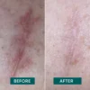 scar pads ALOE VERA | Apricot