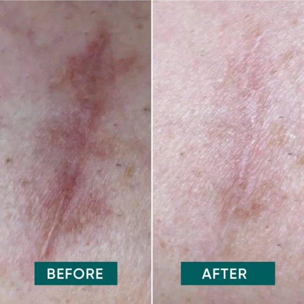 scar pads ALOE VERA | Apricot