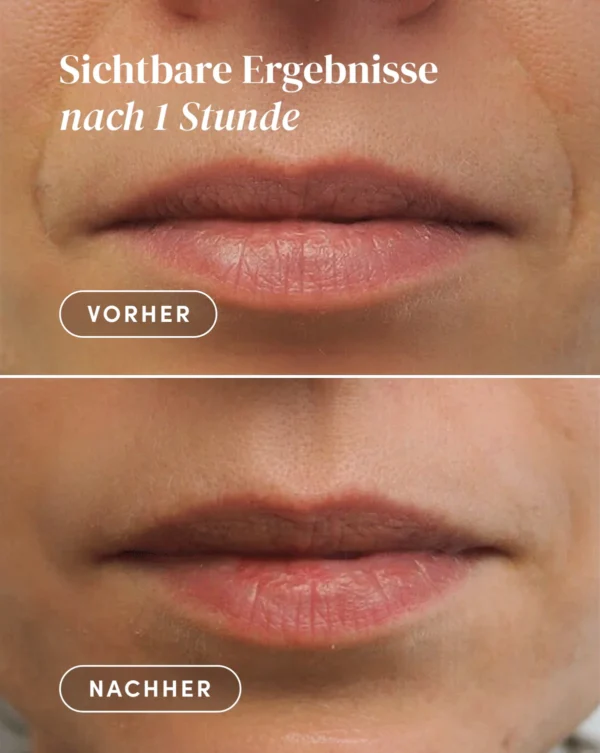 mouth patches2 mouth patches PANTHÉNOL | Apricot