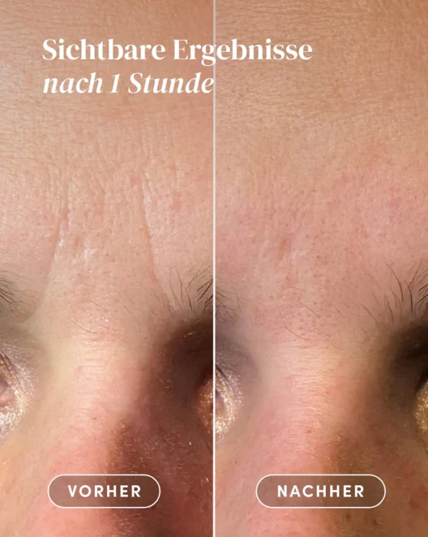 Facial patches hyaluron | Apricot